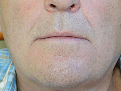 Hős Dent - implantációs protetika 13