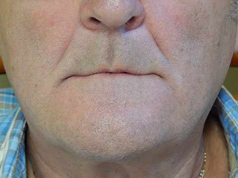 Hős Dent - implantációs protetika 12