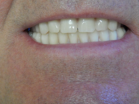 Hős Dent - implantációs protetika 14