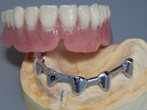 Hős Dent - implantációs protetika 02
