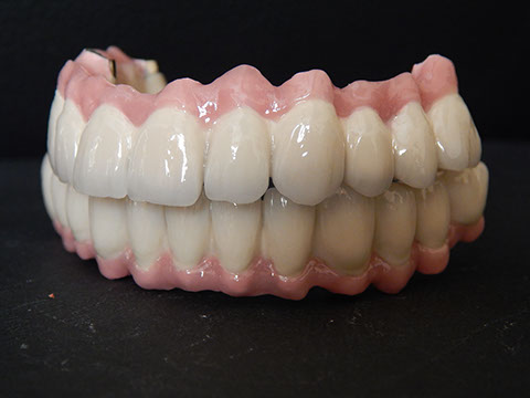 Hős Dent - implantációs protetika 03