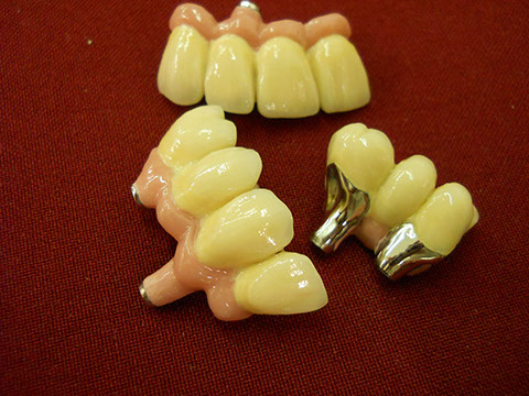 Hős Dent - implantációs protetika 04