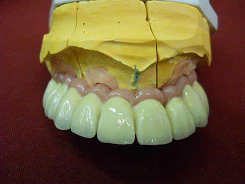 Hős Dent - implantációs protetika 05