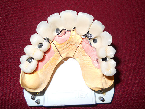 Hős Dent - implantációs protetika 06