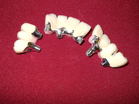 Hős Dent - implantációs protetika 07