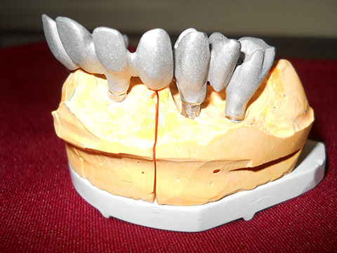 Hős Dent - implantációs protetika 08