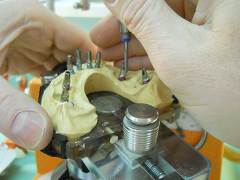 Hős Dent - implantációs protetika 09