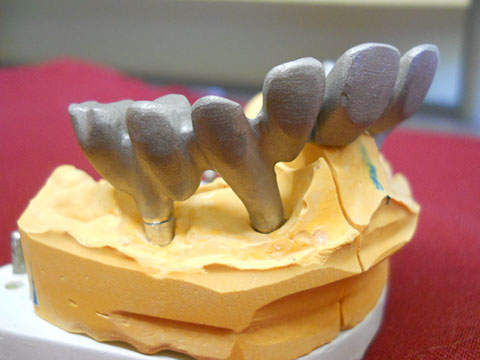 Hős Dent - implantációs protetika 10