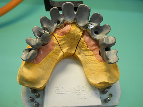 Hős Dent - implantációs protetika 11